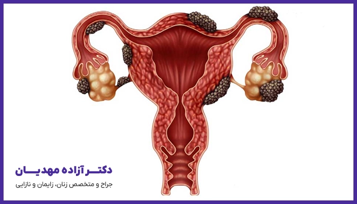 تاثیر آندومتریوز برروی بارداری