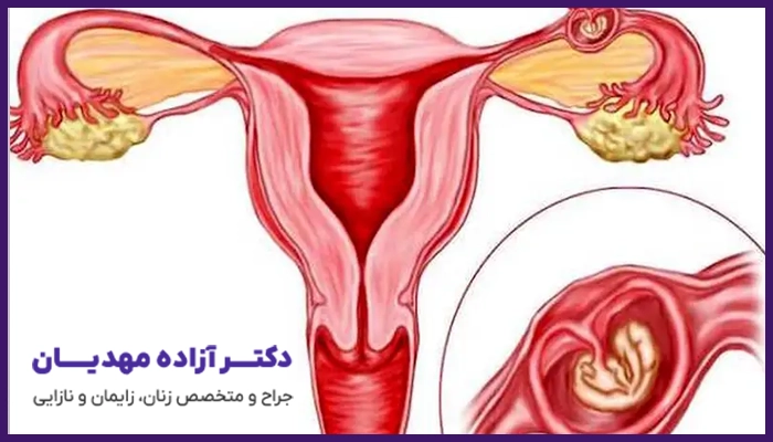 حاملگی خارج از رحم چه علائمی را به همراه دارد؟