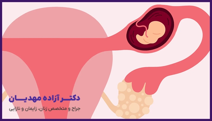 درمان بارداری خارج رحم