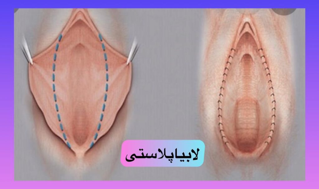 لابیاپلاستی