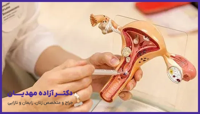 درمان نشدن پولیپ رحم چه مشکلاتی را به همراه دارد؟