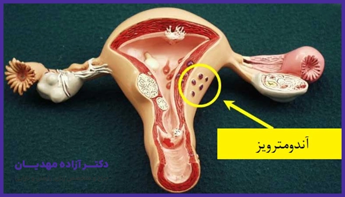 علائم آندومتریوز